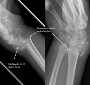 Snowboarder’s wrist – the prevention and treatment of common fractures