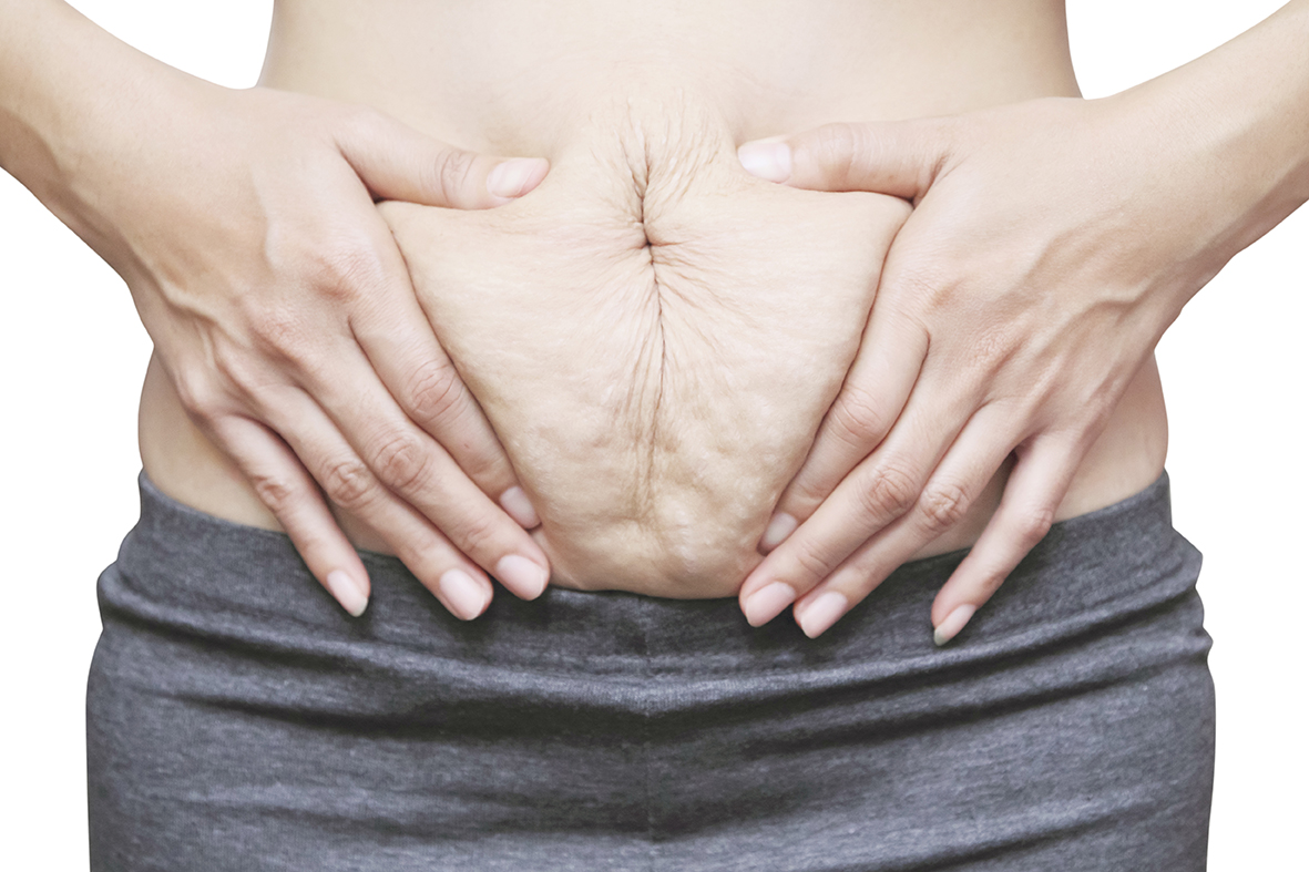 Abdominal separation and what to do about it