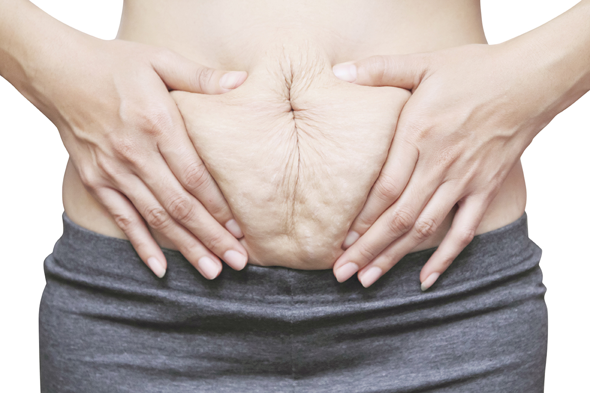 Abdominal Separation During Pregnancy MyHealth Bytes